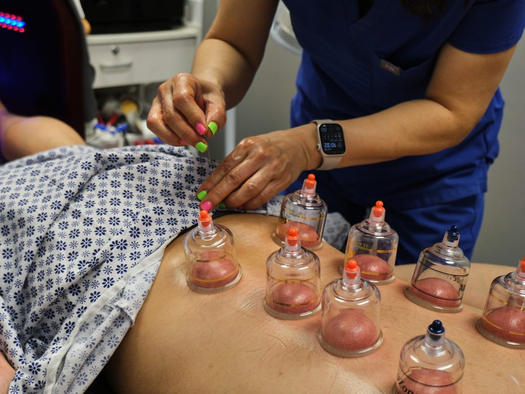 A practitioner providing acupuncture and cupping treatment at Haram