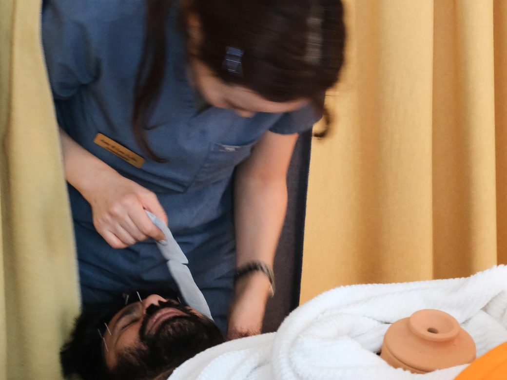 A practitioner attending to a patient during acupuncture, with fine needles in place